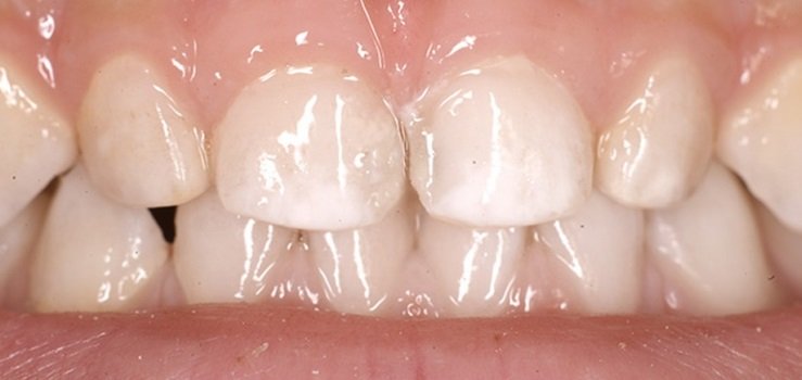 Как бороться с белыми пятнами на зубах