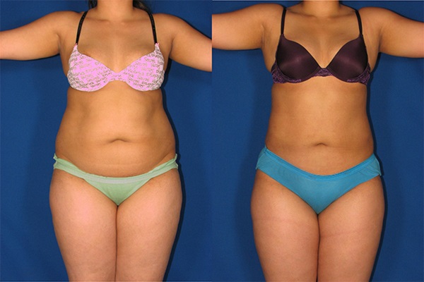 Как избавиться от висцерального жира: фото до и после