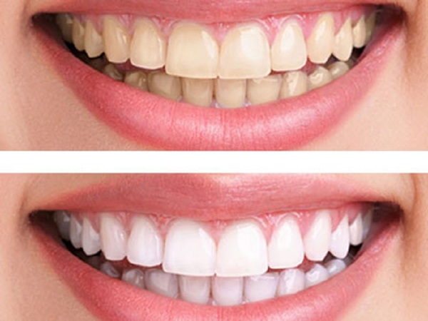 Эффективное отбеливание зубов в домашних условиях