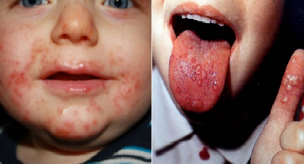Чем опасен вирус Коксаки: симптомы и лечение у детей и взрослых