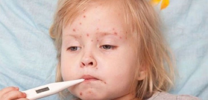 Чем опасен вирус Коксаки: симптомы и лечение у детей и взрослых