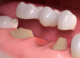Зубные коронки – лучший вариант для протезирования