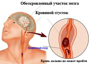 Лечение атеросклероза народными средствами